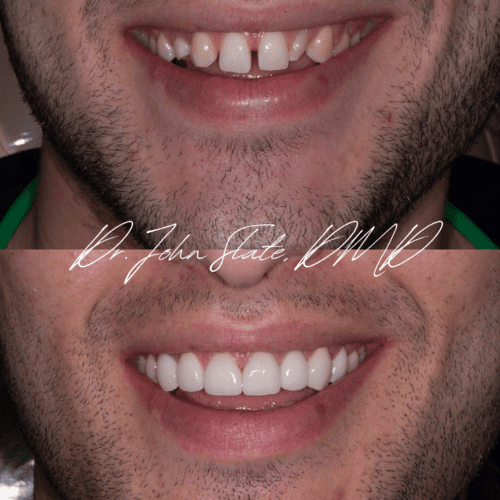 Multidisciplinary reconstruction for missing lateral tooth