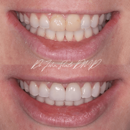 Post orthodontic porcelain veneers