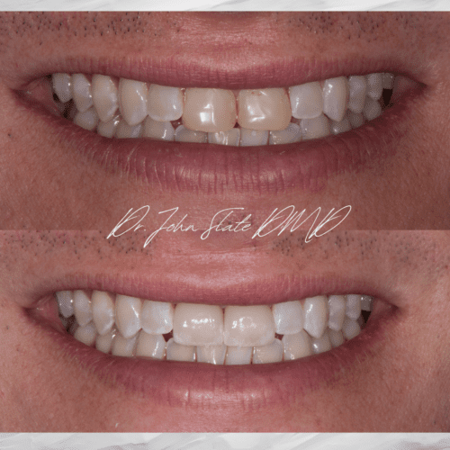 Replacement of older composite veneers with porcelain