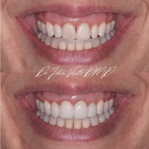 Crown replacement and porcelain veneers