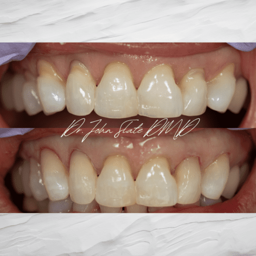 Composite bonding to restore abfractions and cervical lesions