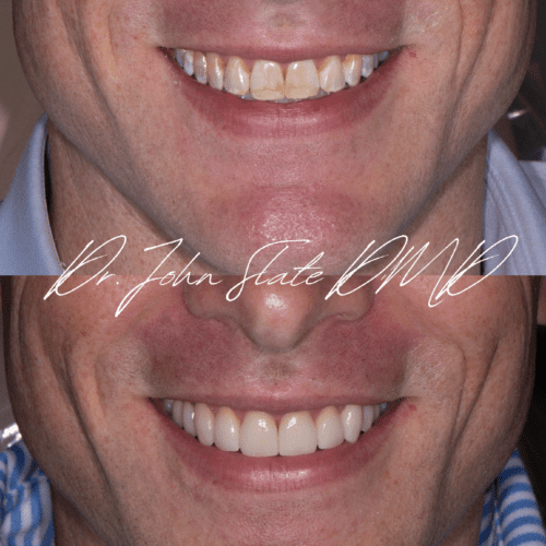 Porcelain veneers treating developmental white spot lesions