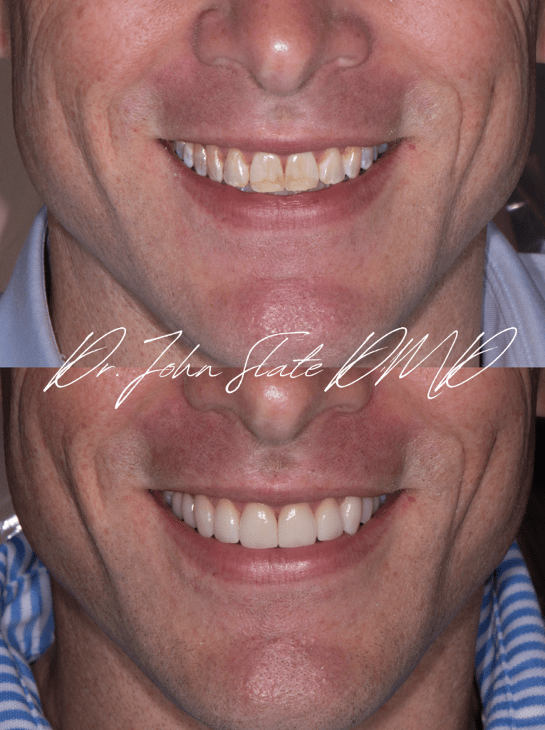 Porcelain veneers before and after in Washington DC, correction of developmental discoloration with pressed lithium disilicate by Dr. John Slate