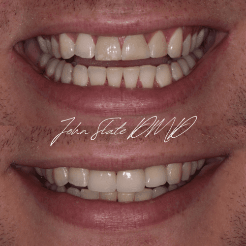 Full coverage porcelain crowns following dental trauma