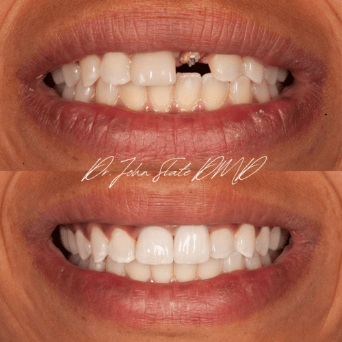 Post and core build up with porcelain crowns