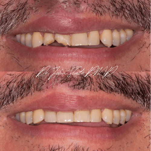 Post-trauma root canal and porcelain crowns