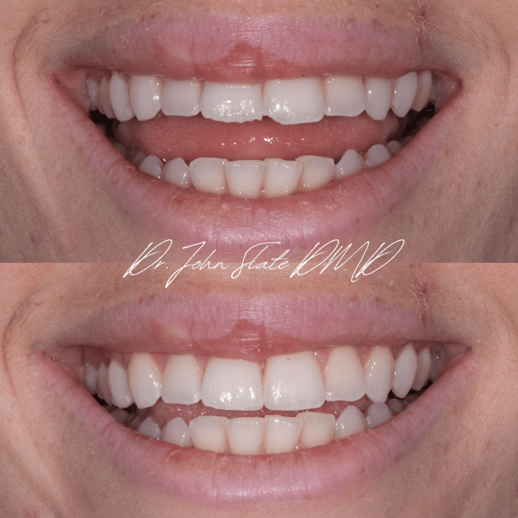 Same day dental bonding for chipped front teeth in Bethesda and NW DC.