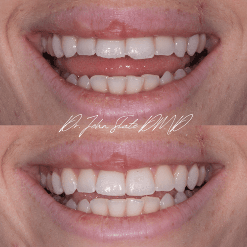 Incisal edge composite bonding