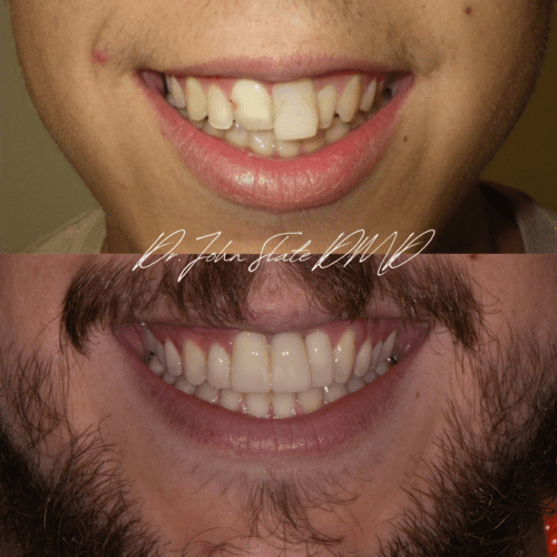Anterior teeth restoration following trauma and external resorption