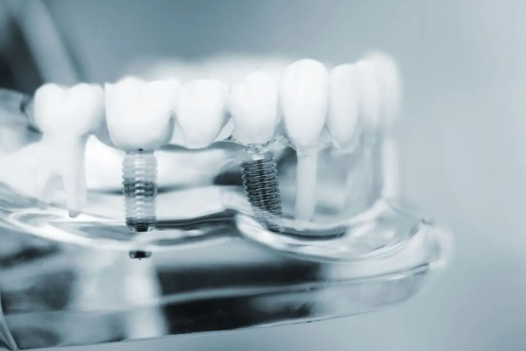 Oral Health Benefits of Dental Implants