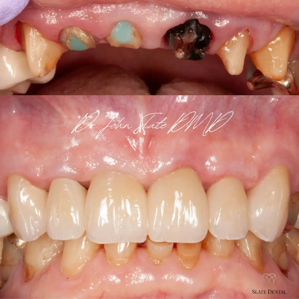 Six-unit zirconia dental bridge before and after in Washington DC by Dr. John Slate, restoring fractured and decayed upper front teeth