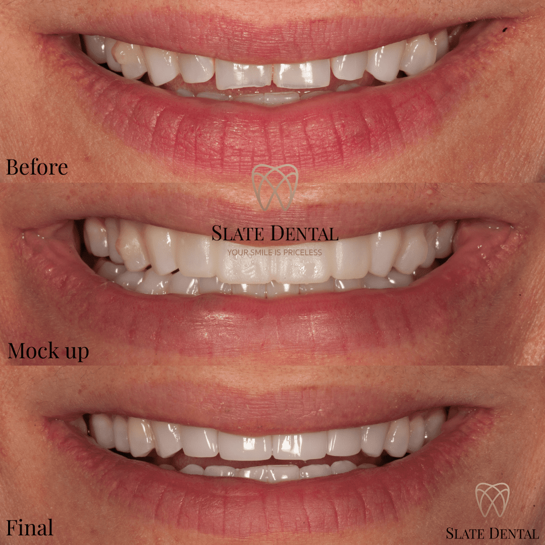 Before and after smiling profile view showing 4 custom porcelain veneers used to close diastema spacing and restore worn central incisors for a natural look at Slate Dental Washington DC.