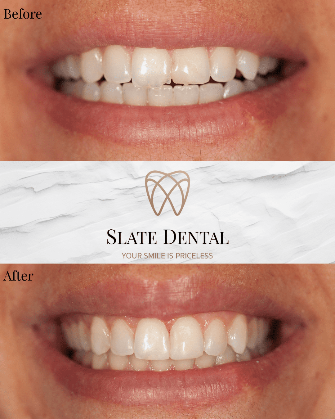 Before and after dental bonding for chipped front central incisors after trauma in NW DC.
