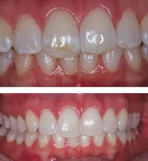 Enamel microabrasion Washington DC before and after white spot lesion treatment