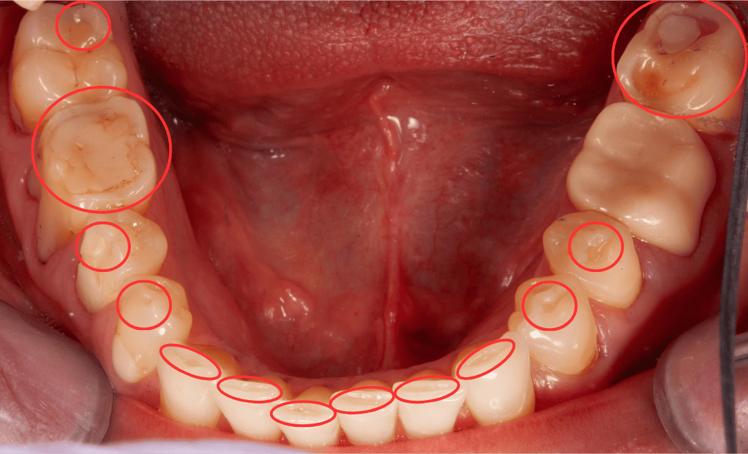 Lower teeth from above with circled wear on flattened front teeth and cupped back teeth, next to an earlier molar restoration