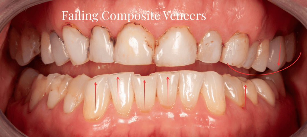 Front view of worn teeth with stained, failing composite bonding on the upper front teeth and flattened lower front teeth