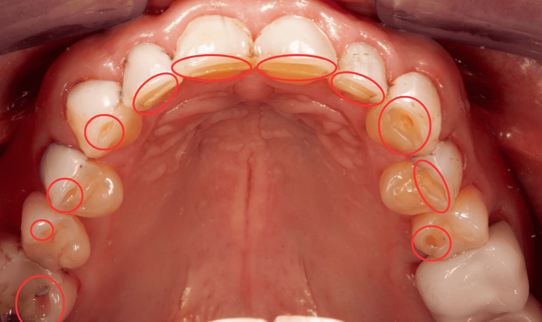 Upper teeth from above with circled wear: flattened, thinned front edges and cupped premolars from acid erosion and grinding