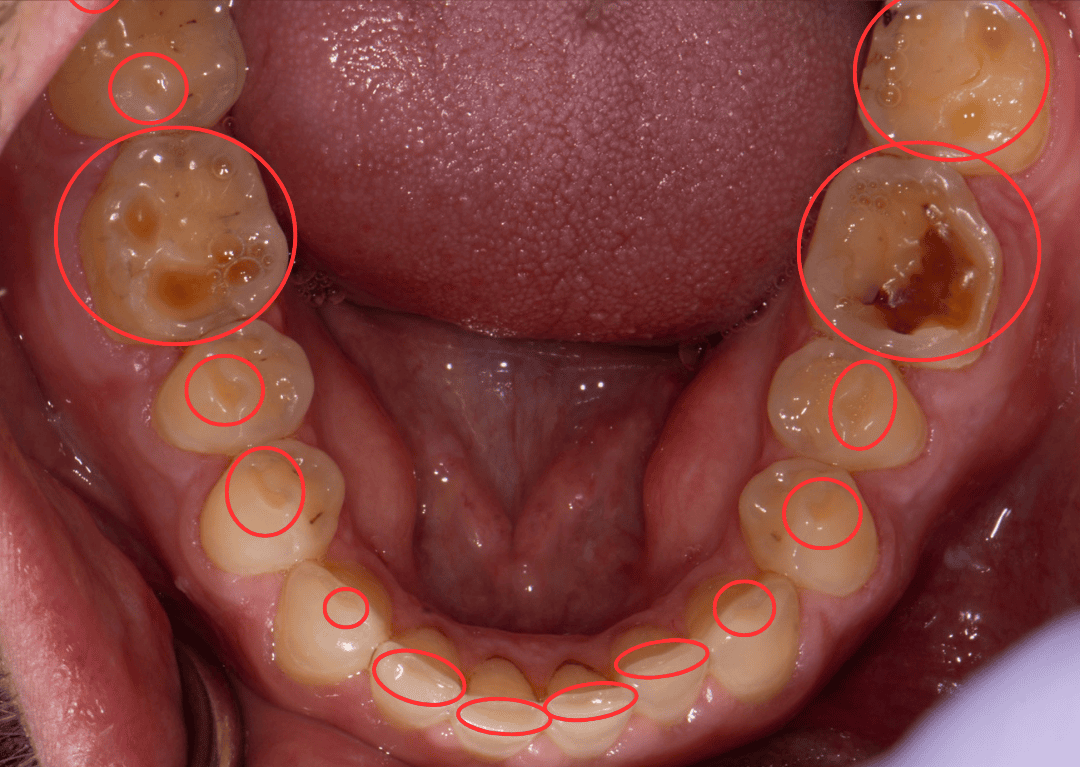 Lower teeth from above with circled areas of wear: deeply cupped molars with exposed yellow dentin and flattened front teeth