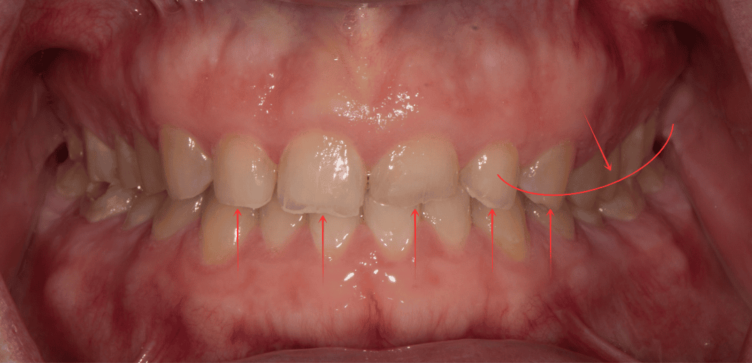 Front view of a closed bite with arrows marking flattened front teeth and a curve tracing an uneven chewing plane