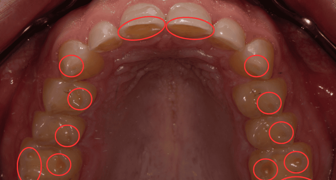 Upper teeth from above with circled areas of acid erosion: small cupped pits on the back teeth and worn front edges
