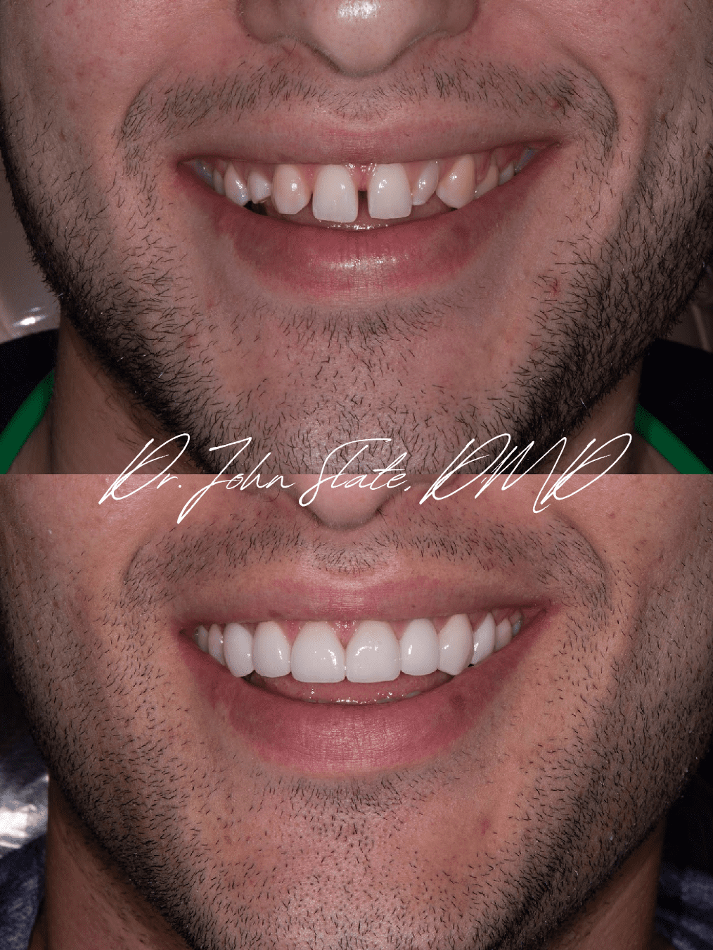 Full mouth reconstruction before and after photos of congenitally missing teeth case