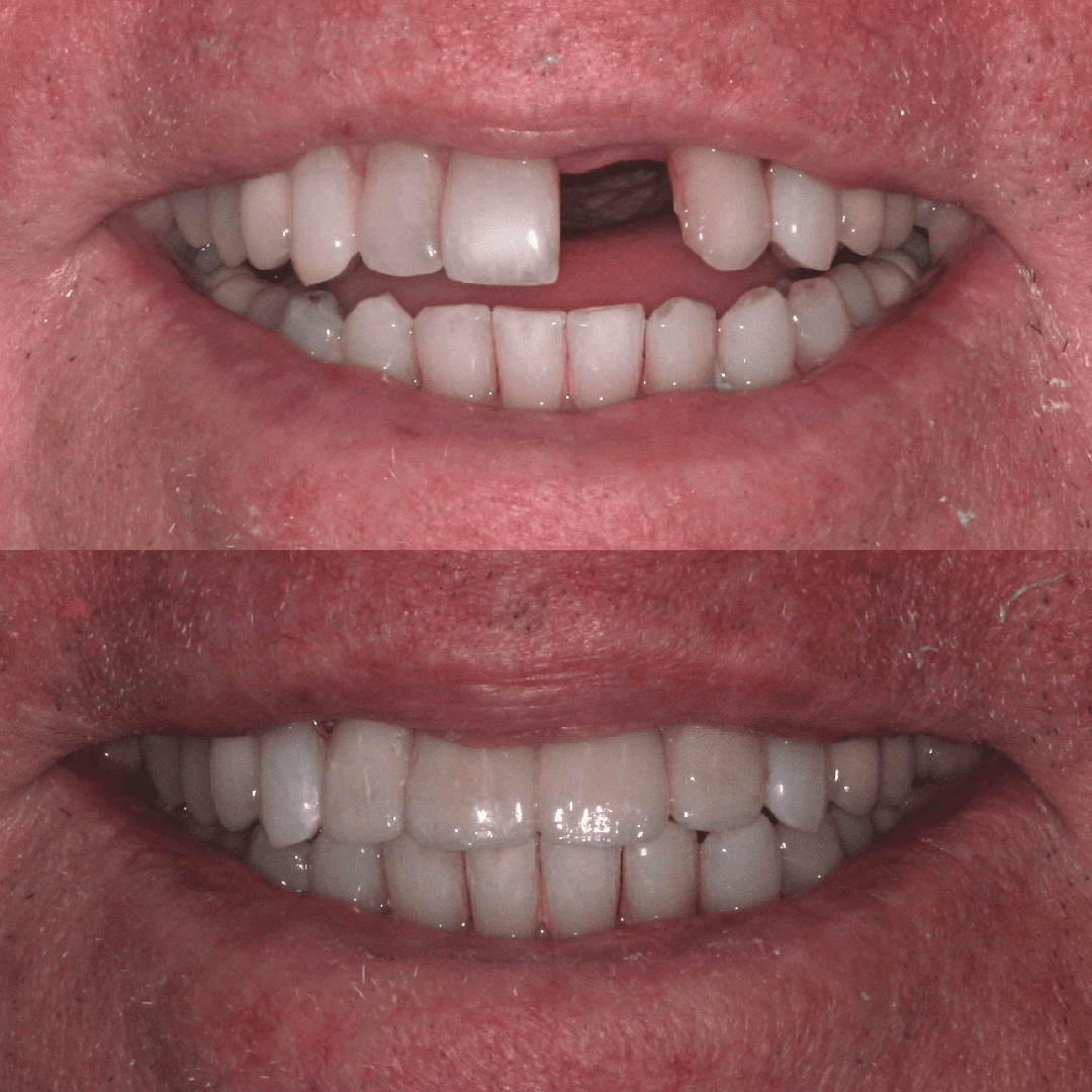 Porcelain-fused-to-metal anterior dental bridge before and after in Washington DC by Dr. John Slate, replacing fractured upper front tooth