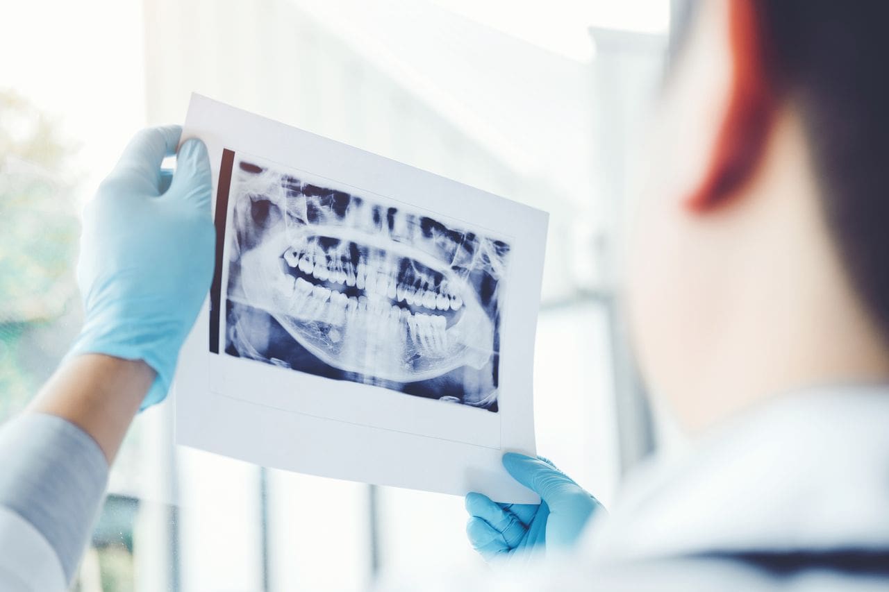 Tooth Extraction in Washington, DC