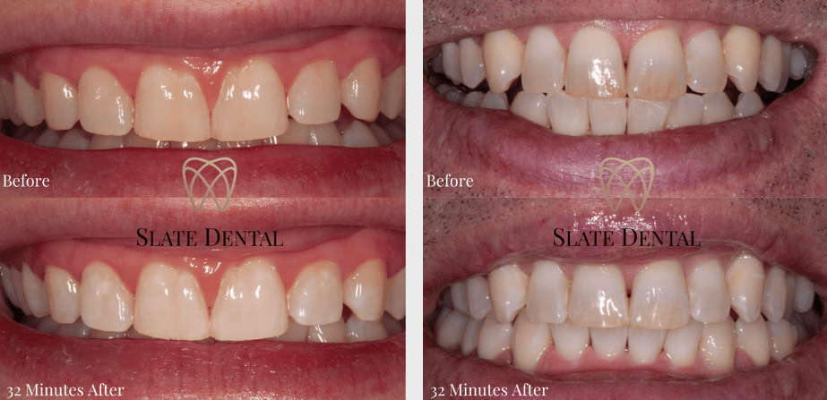 Before and after teeth whitening in Washington DC
