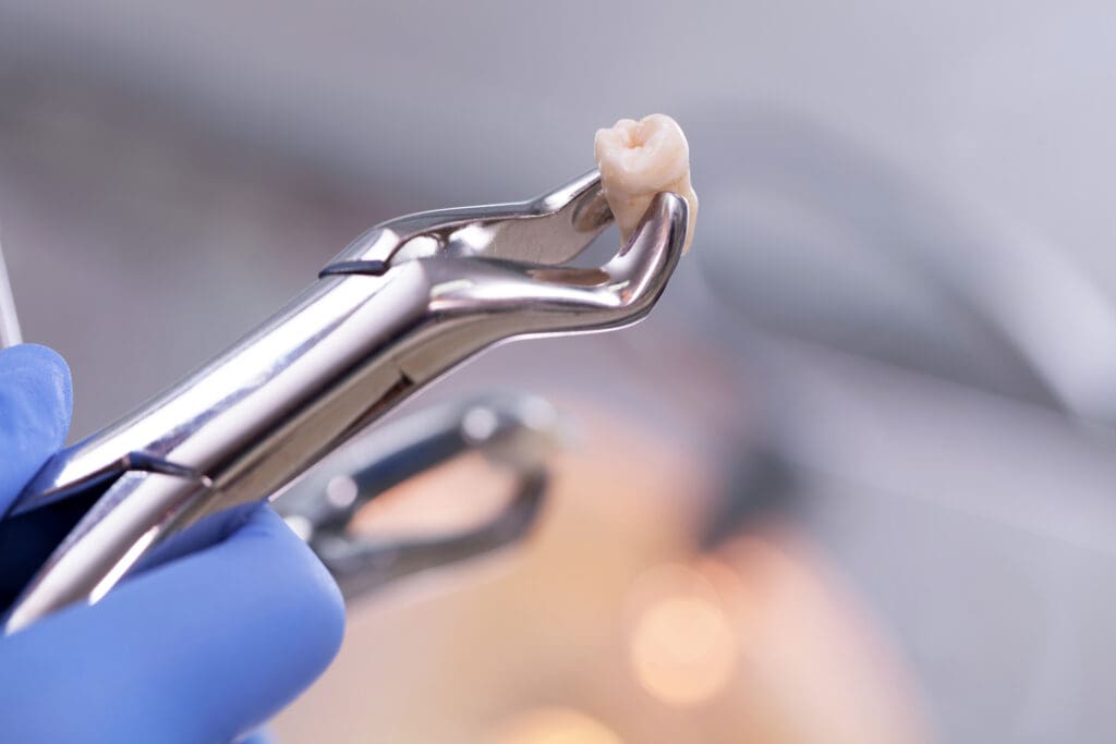 Understanding when you might need a tooth extraction could ease your concerns and help you make informed decisions about your oral health.