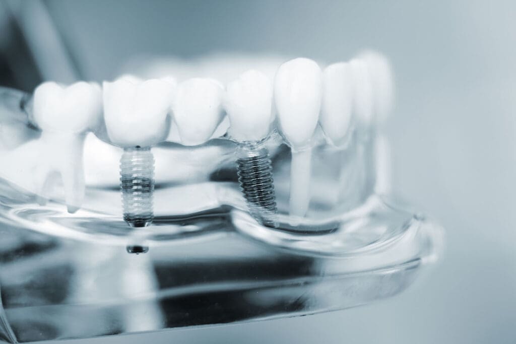 Oral Health Benefits of Dental Implants