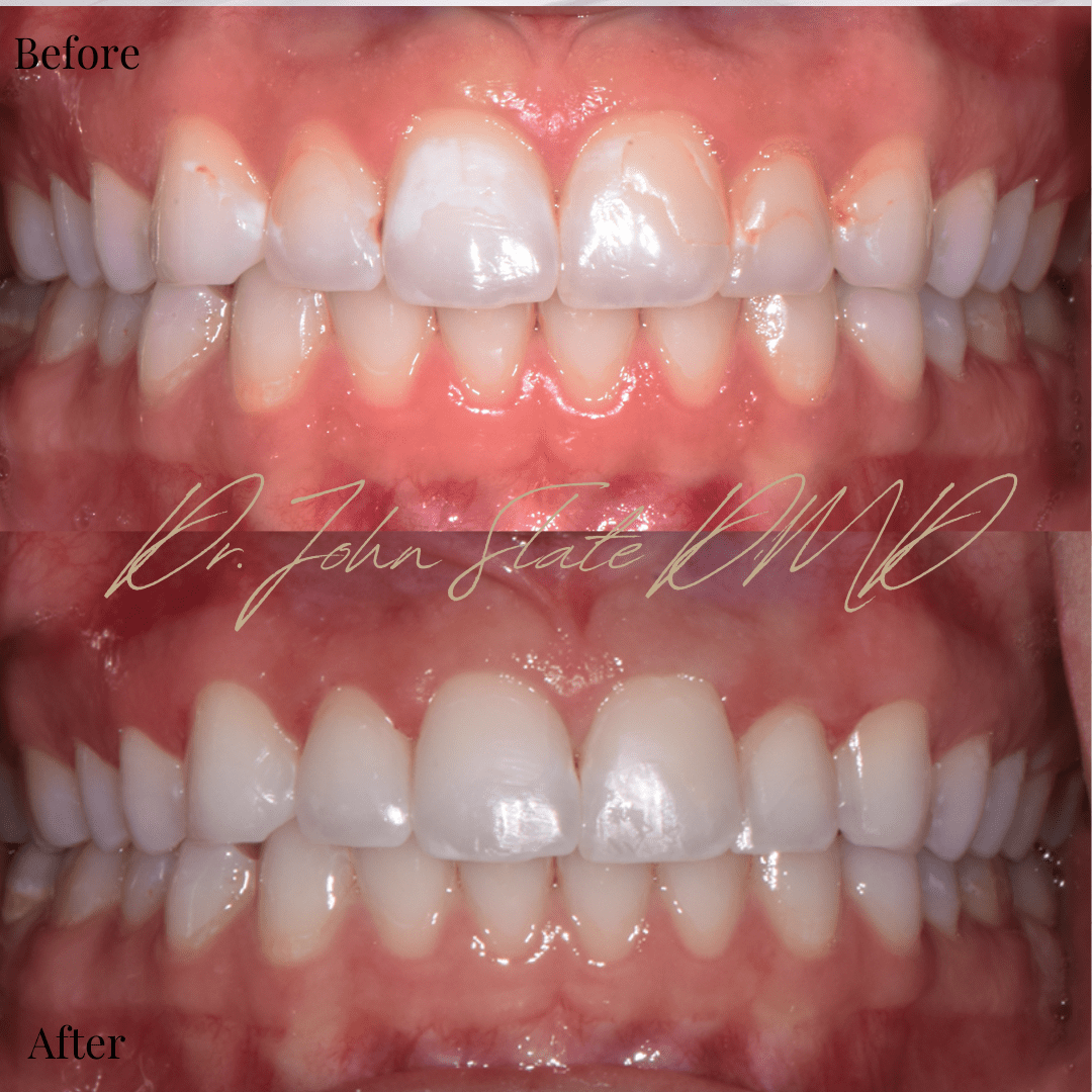 Before and after dental bonding for white spot lesions and aged composite replacement in Chevy Chase.