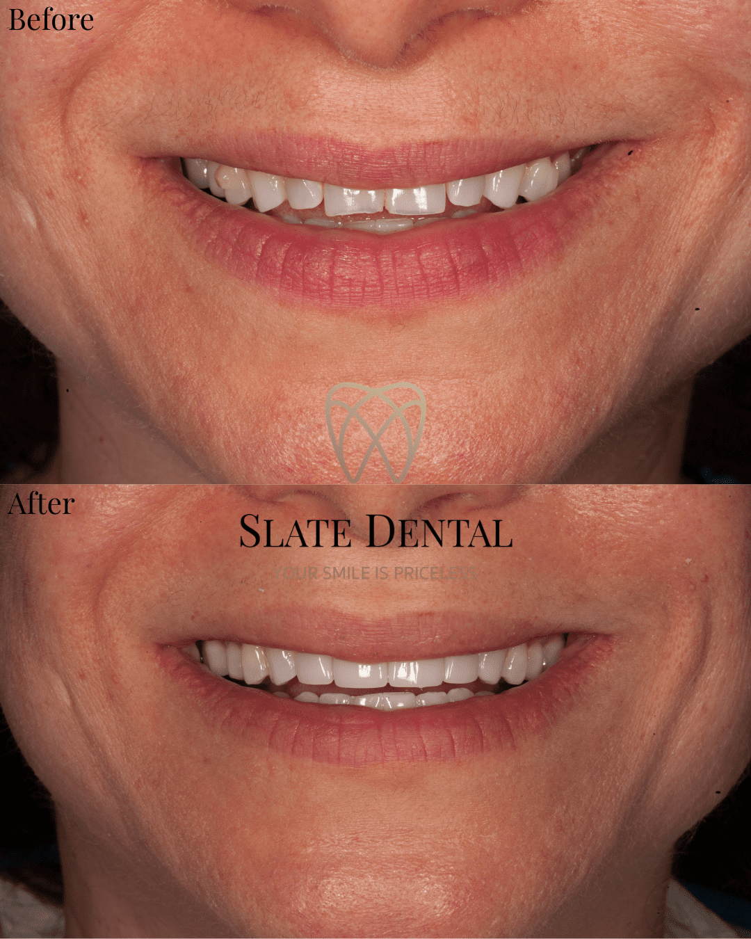 Concierge service cosmetic dentistry. Four customized veneers to restore full form and function at Slate Dental in Washington DC