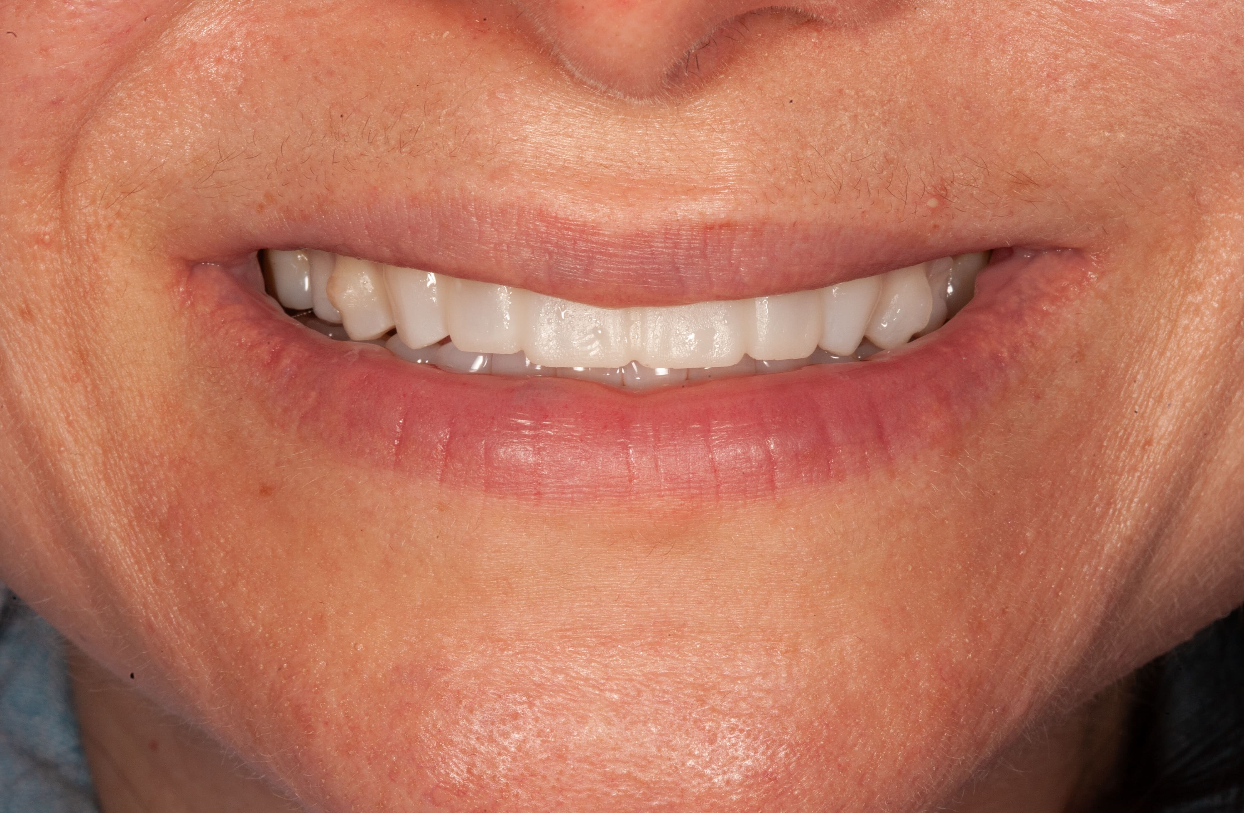 Patient trying in the temporary mock-up smile design at Slate Dental DC.