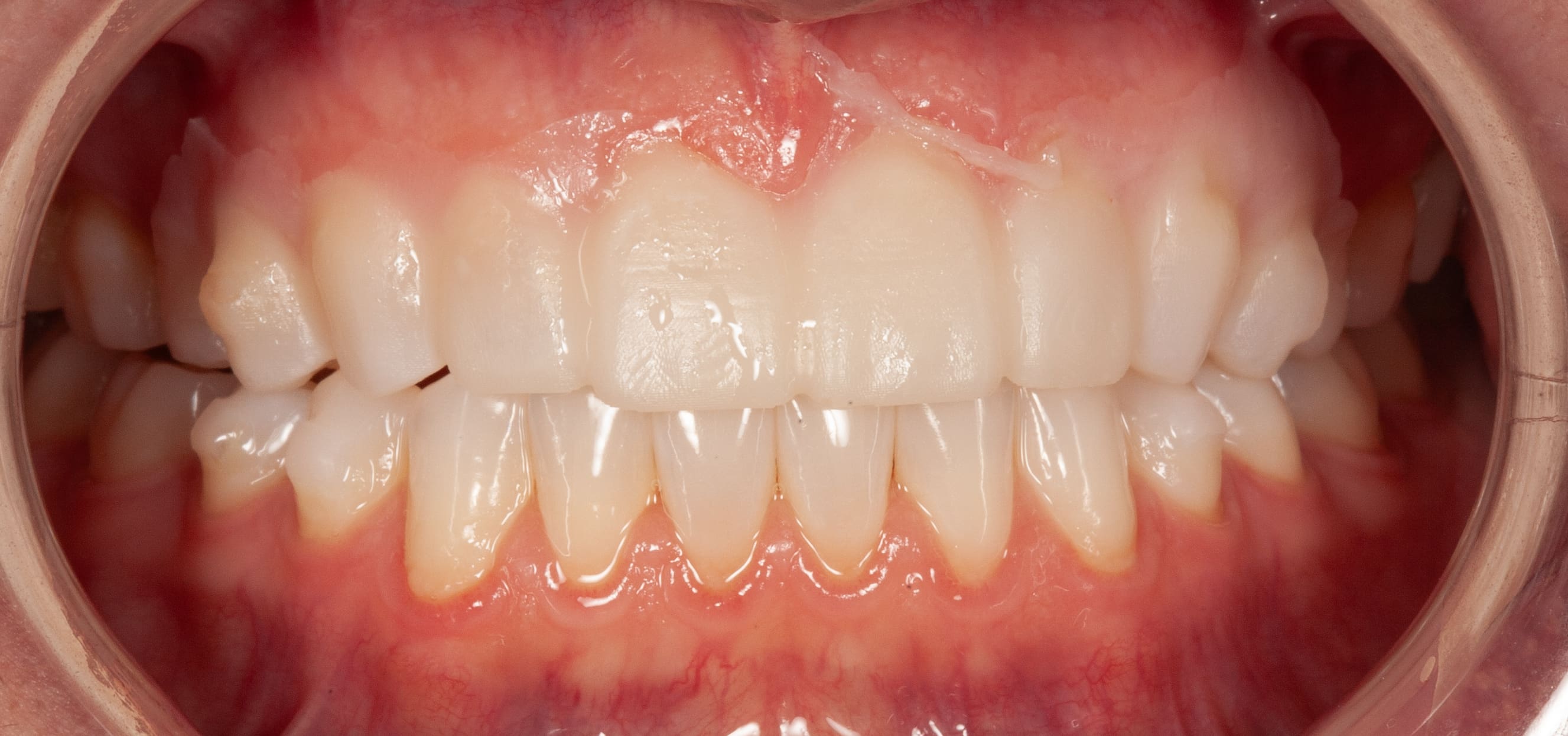 Patient trying in the temporary mock-up smile design at Slate Dental DC