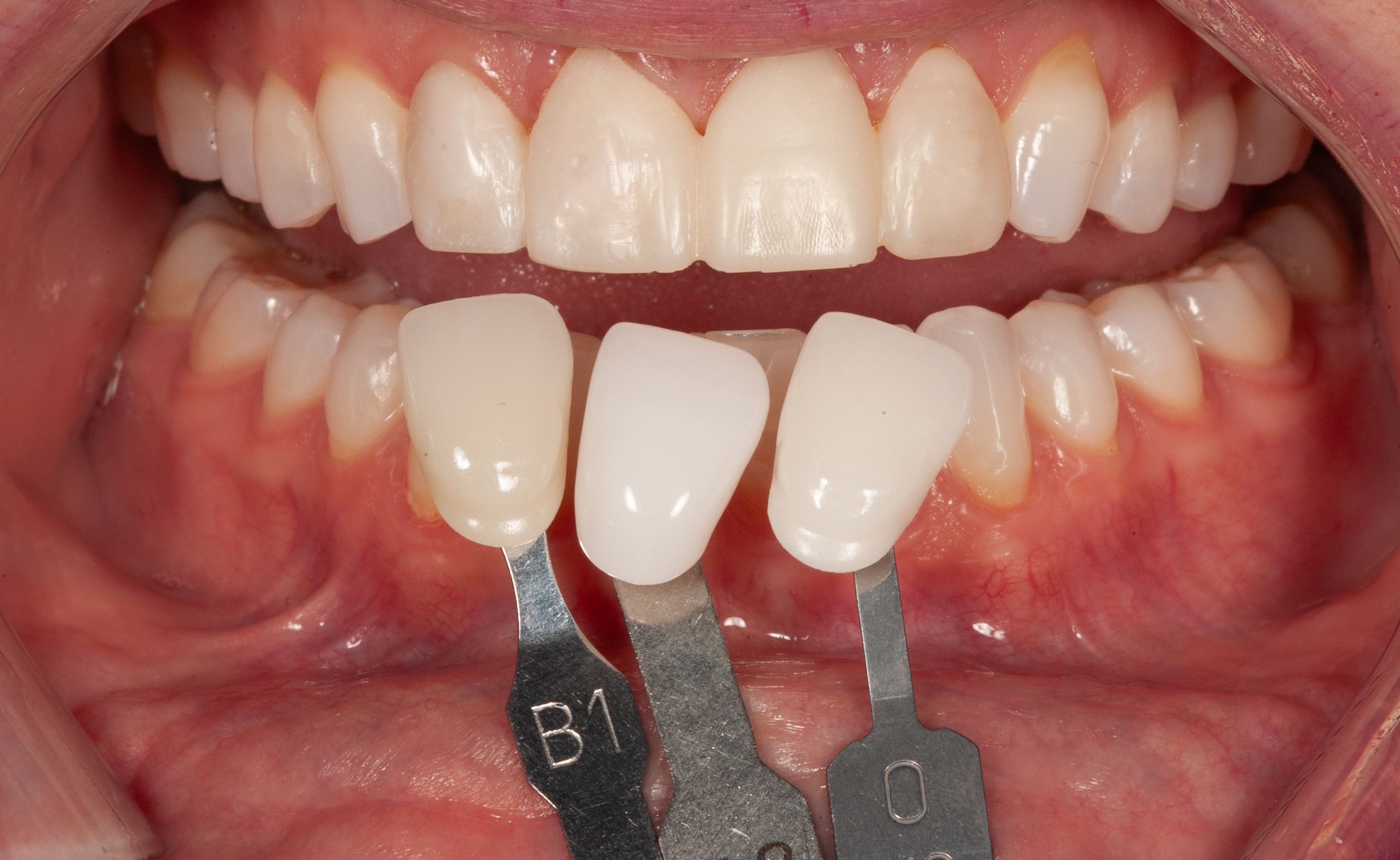 Custom temporary or protype veneers allow the patient to test the function of her new smile.