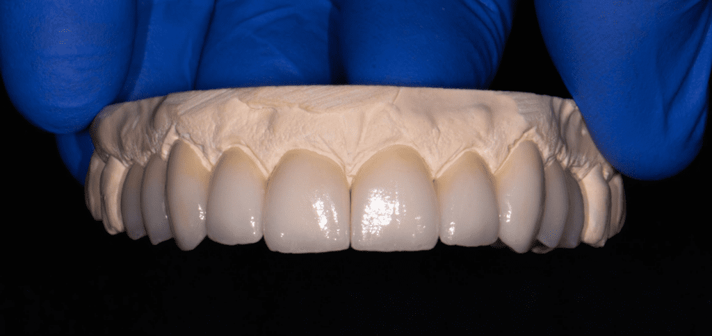 A detailed close-up photograph of a maxillary dental stone model, which is held by a blue-gloved hand. The model displays a complete, finished set of white ceramic dental crowns covering the teeth from the left first premolar to the right first premolar, inclusive. The teeth are symmetrical and the crowns are highly finished, viewed against a dark background.