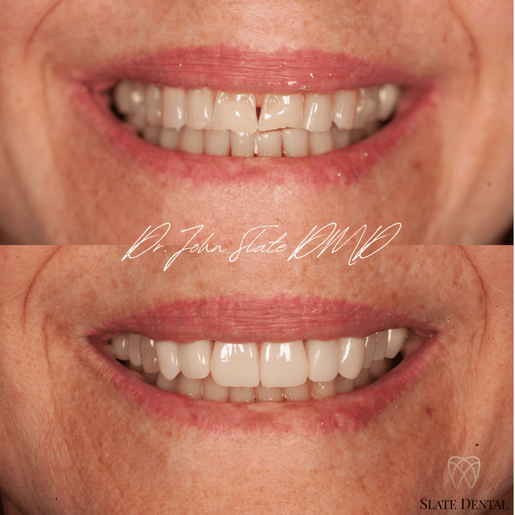 Porcelain veneers before and after Washington DC - restoration of worn flattened teeth - Slate Dental
