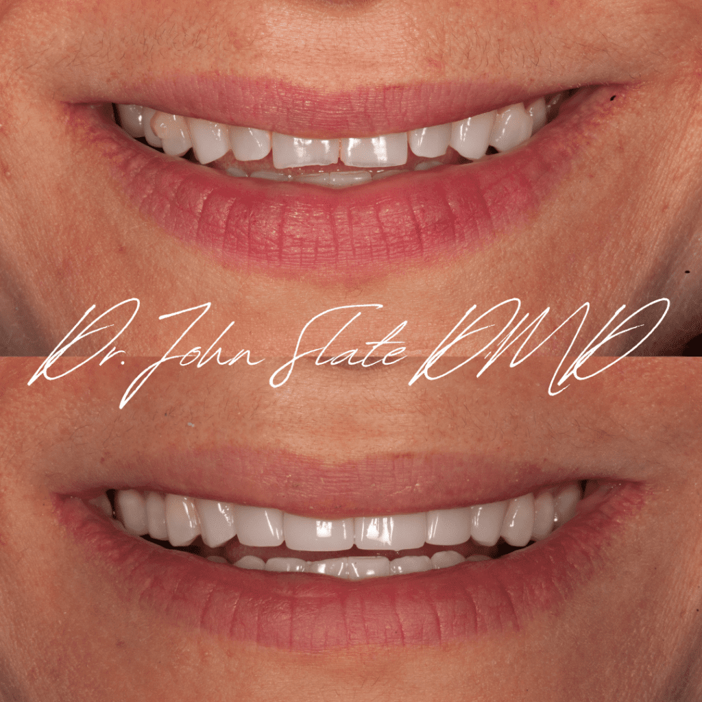 Porcelain veneers before and after Washington DC - correction of discoloration and chipping - Slate Dental