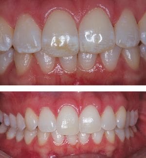 Enamel microabrasion Washington DC before and after white spot lesion treatment